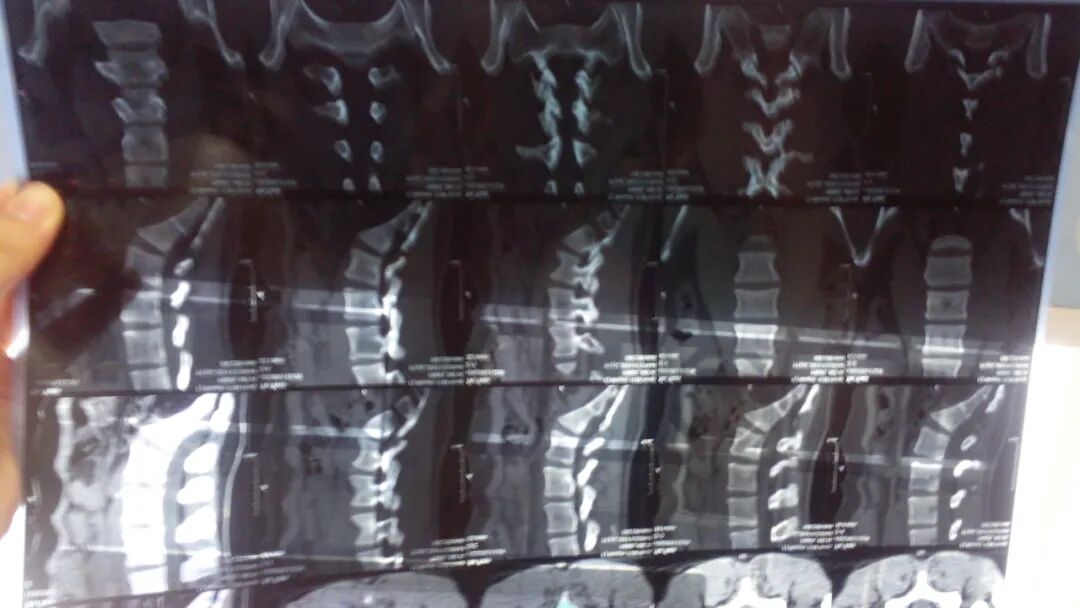 睡出来的腰肌劳损：当下中国人的很多病，都是因为家具太软了