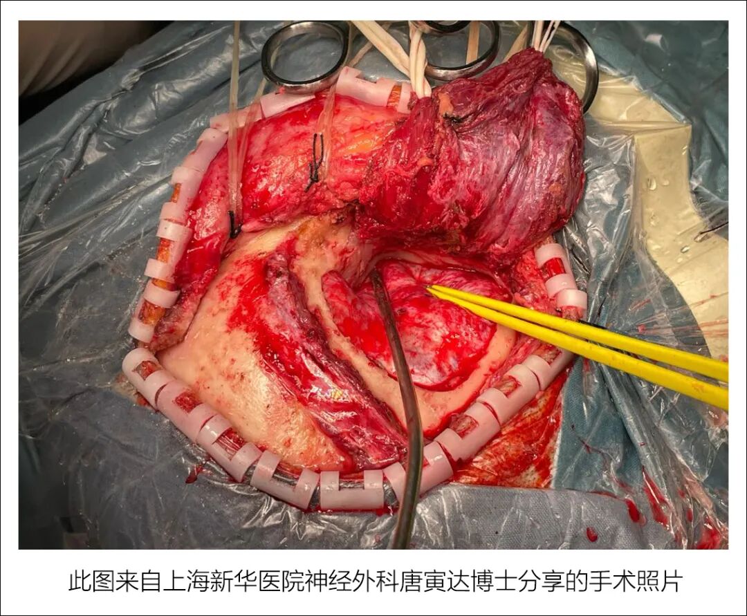 学习笔记 | 额颞开颅基底节血肿清除术思考_医学界-助力医生临床决策