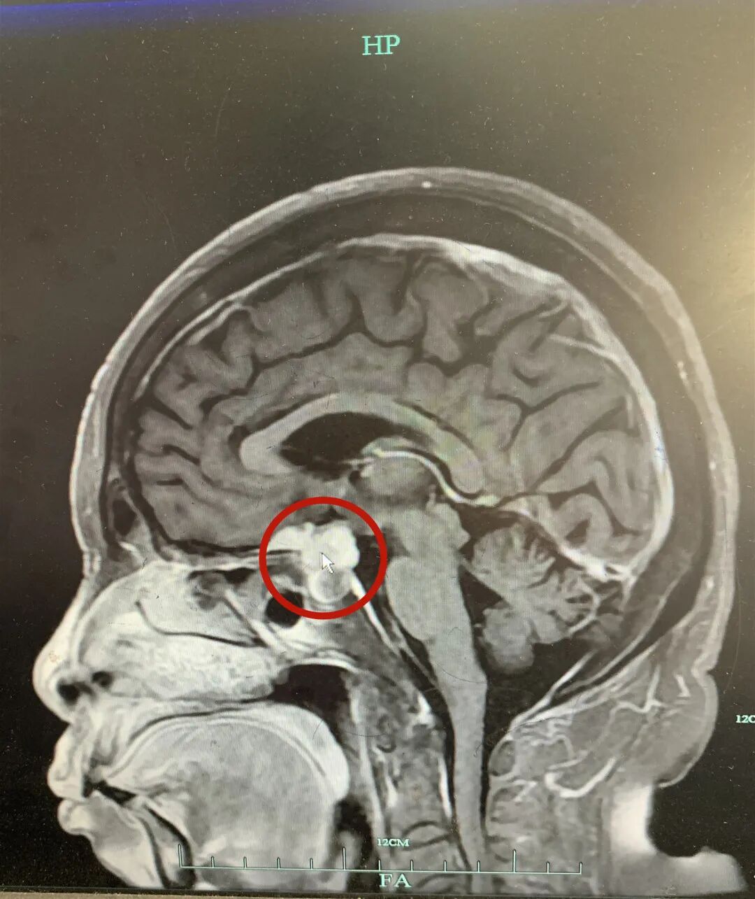 根据影像数据显示,鞍区的肿块大小约21*15*20mm,已经压迫到了视神经