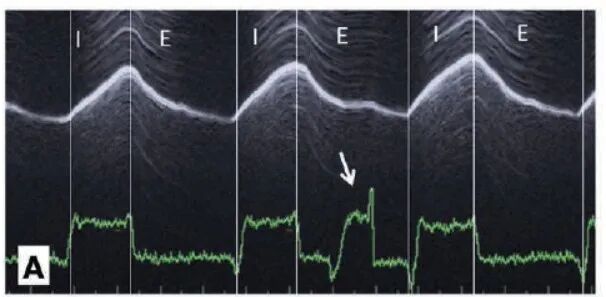 为什么呼吸机人机同步人机不同步的监测与识别_https://www.jmylbn.com_新闻资讯_第22张