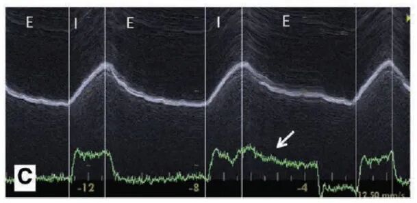 为什么呼吸机人机同步人机不同步的监测与识别_https://www.jmylbn.com_新闻资讯_第25张