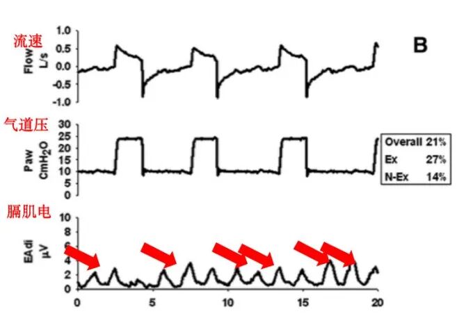 为什么呼吸机人机同步人机不同步的监测与识别_https://www.jmylbn.com_新闻资讯_第4张
