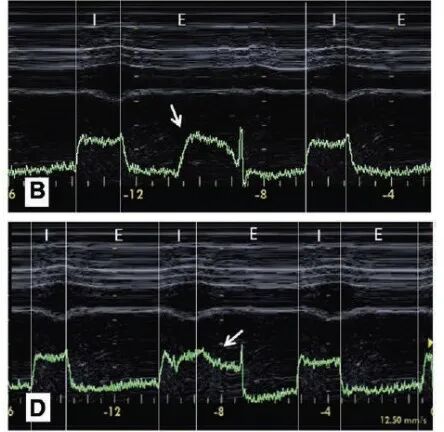 为什么呼吸机人机同步人机不同步的监测与识别_https://www.jmylbn.com_新闻资讯_第26张