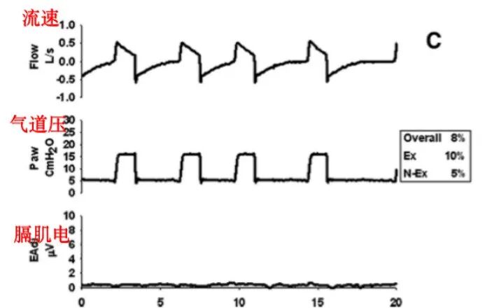 为什么呼吸机人机同步人机不同步的监测与识别_https://www.jmylbn.com_新闻资讯_第5张