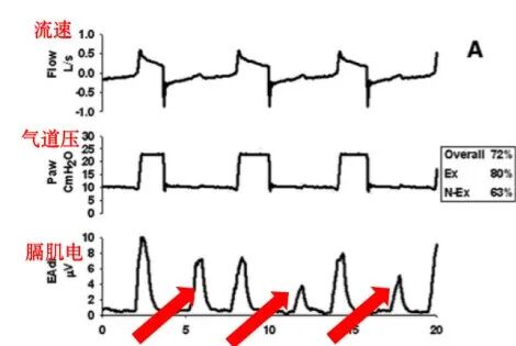 为什么呼吸机人机同步人机不同步的监测与识别_https://www.jmylbn.com_新闻资讯_第3张