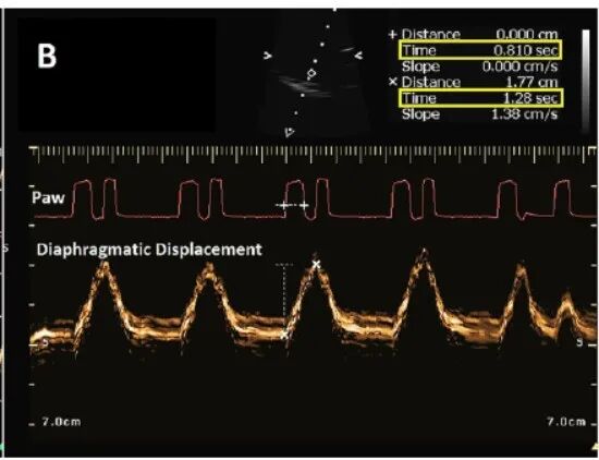 为什么呼吸机人机同步人机不同步的监测与识别_https://www.jmylbn.com_新闻资讯_第24张