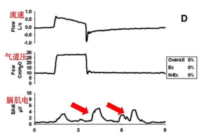 为什么呼吸机人机同步人机不同步的监测与识别_https://www.jmylbn.com_新闻资讯_第6张