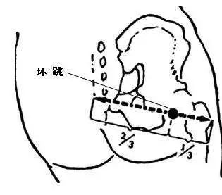 骶管裂孔定位图片