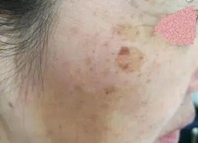 脂溢性角化病