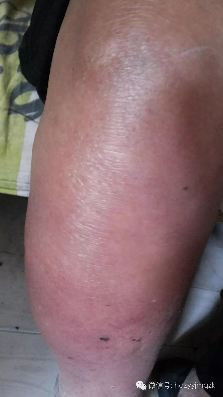 患上静脉炎的人除了有静脉肿胀这个表现外,通常还有以下症状