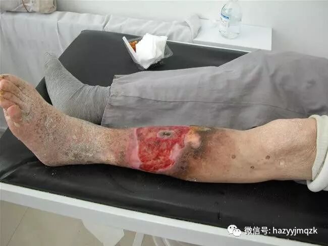 下肢动脉硬化闭塞症的症状分期