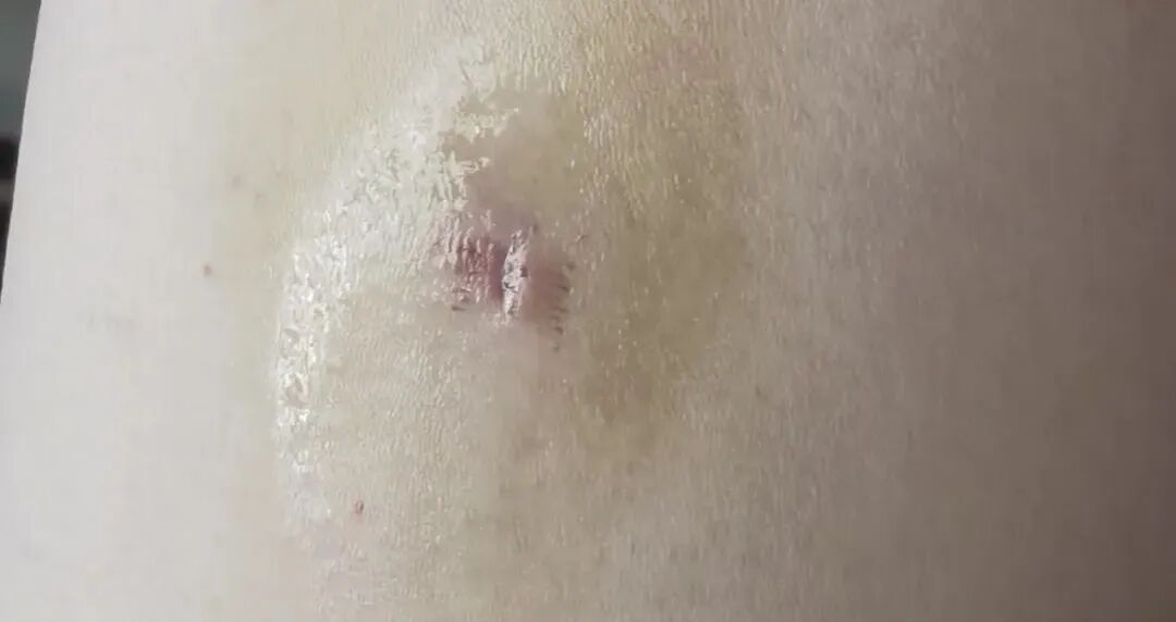 医院DR怎么消毒液体创可贴：促进湿性愈合，消毒防护，有娃必备！_https://www.jmylbn.com_新闻资讯_第3张