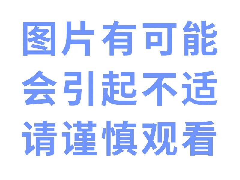 怎么区分显微剪刀天生剪刀手️——显微外科带你了解什么是多指畸形_https://www.jmylbn.com_新闻资讯_第8张