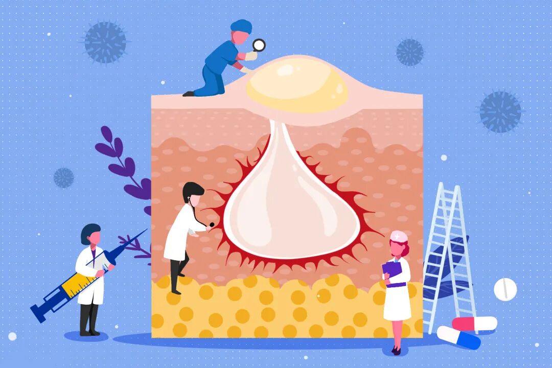 kinglaser激光怎么样医学美容中心：反复长痘痘就是好不了？保姆级战”痘”攻略请收好_https://www.jmylbn.com_新闻资讯_第11张