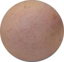 点阵激光后冷敷怎么敷非剥脱点阵激光：让你“一键”磨皮，悄然变美【美肤治肤】_https://www.jmylbn.com_新闻资讯_第9张