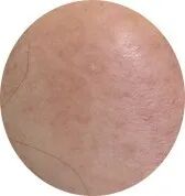 点阵激光后冷敷怎么敷非剥脱点阵激光：让你“一键”磨皮，悄然变美【美肤治肤】_https://www.jmylbn.com_新闻资讯_第8张