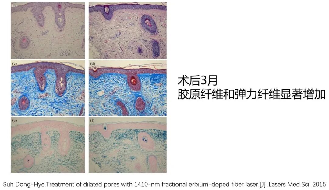 点阵激光后冷敷怎么敷非剥脱点阵激光：让你“一键”磨皮，悄然变美【美肤治肤】_https://www.jmylbn.com_新闻资讯_第5张