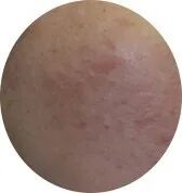 点阵激光后冷敷怎么敷非剥脱点阵激光：让你“一键”磨皮，悄然变美【美肤治肤】_https://www.jmylbn.com_新闻资讯_第7张