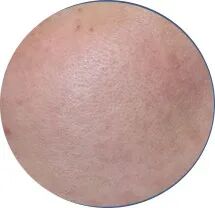 点阵激光后冷敷怎么敷非剥脱点阵激光：让你“一键”磨皮，悄然变美【美肤治肤】_https://www.jmylbn.com_新闻资讯_第10张