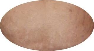 点阵激光后冷敷怎么敷非剥脱点阵激光：让你“一键”磨皮，悄然变美【美肤治肤】_https://www.jmylbn.com_新闻资讯_第12张