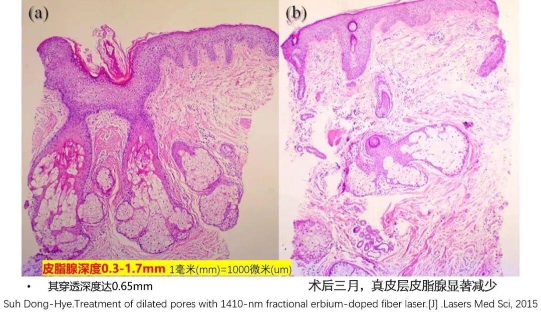 点阵激光后冷敷怎么敷非剥脱点阵激光：让你“一键”磨皮，悄然变美【美肤治肤】_https://www.jmylbn.com_新闻资讯_第6张