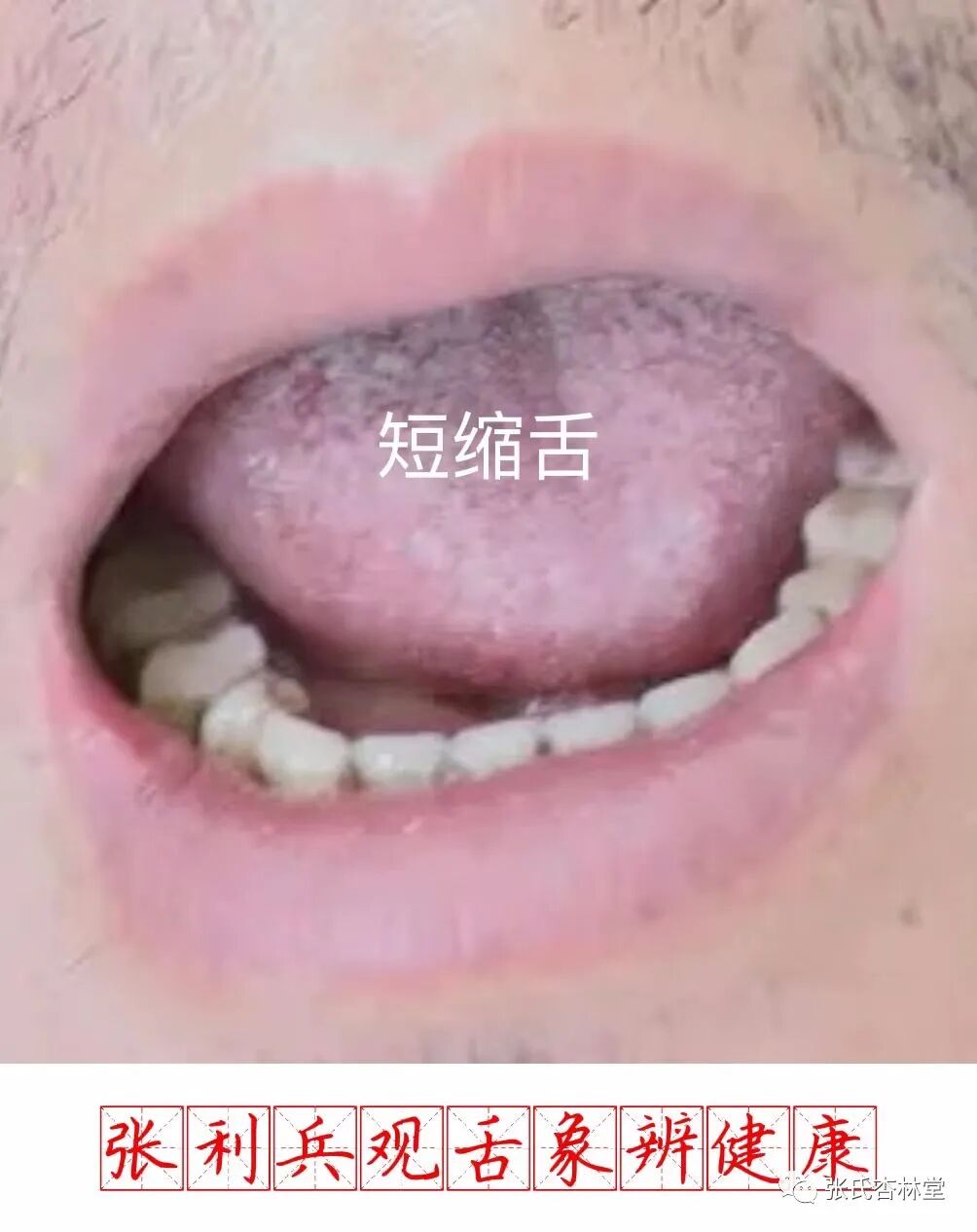 舌头短是什么原因
