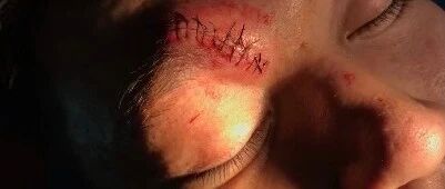 张宁送医！缝16针后，最男人的一幕出现了