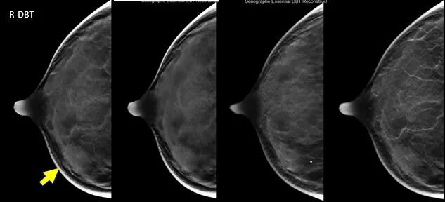 数字化乳腺摄影是什么新技术｜石大一附院数字化乳腺断层摄影技术（DBT ） 让乳腺癌无处可藏！_https://www.jmylbn.com_新闻资讯_第9张