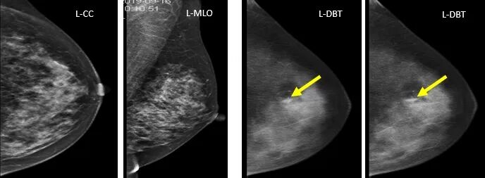 数字化乳腺摄影是什么新技术｜石大一附院数字化乳腺断层摄影技术（DBT ） 让乳腺癌无处可藏！_https://www.jmylbn.com_新闻资讯_第6张