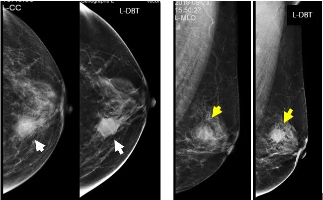 数字化乳腺摄影是什么新技术｜石大一附院数字化乳腺断层摄影技术（DBT ） 让乳腺癌无处可藏！_https://www.jmylbn.com_新闻资讯_第2张