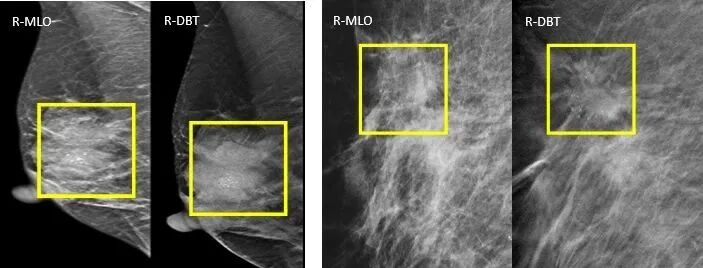 数字化乳腺摄影是什么新技术｜石大一附院数字化乳腺断层摄影技术（DBT ） 让乳腺癌无处可藏！_https://www.jmylbn.com_新闻资讯_第5张
