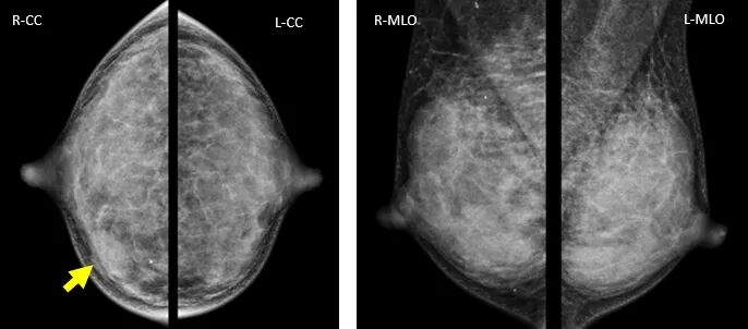 数字化乳腺摄影是什么新技术｜石大一附院数字化乳腺断层摄影技术（DBT ） 让乳腺癌无处可藏！_https://www.jmylbn.com_新闻资讯_第8张