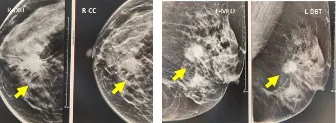 数字化乳腺摄影是什么新技术｜石大一附院数字化乳腺断层摄影技术（DBT ） 让乳腺癌无处可藏！_https://www.jmylbn.com_新闻资讯_第4张