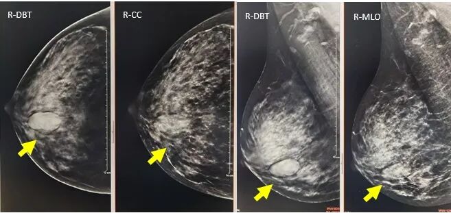 数字化乳腺摄影是什么新技术｜石大一附院数字化乳腺断层摄影技术（DBT ） 让乳腺癌无处可藏！_https://www.jmylbn.com_新闻资讯_第3张