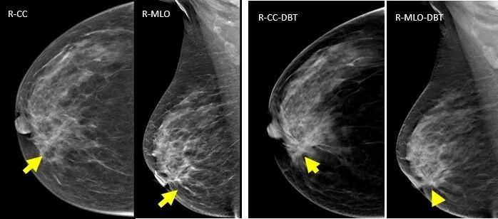 数字化乳腺摄影是什么新技术｜石大一附院数字化乳腺断层摄影技术（DBT ） 让乳腺癌无处可藏！_https://www.jmylbn.com_新闻资讯_第7张