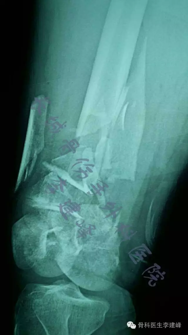 股骨远端骨折---固定方式决定手术成败!