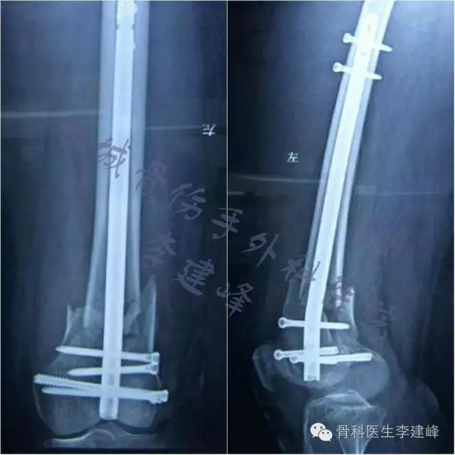 股骨远端骨折---固定方式决定手术成败!