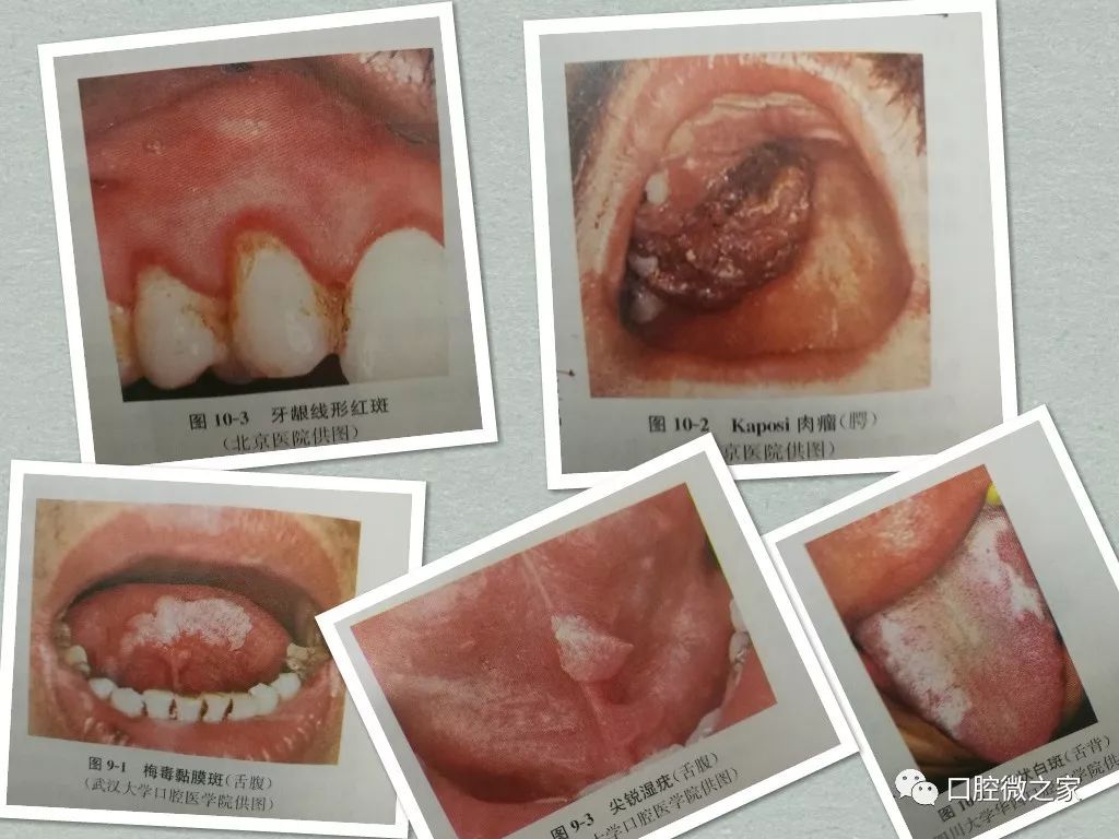 淋菌性口腔炎图片