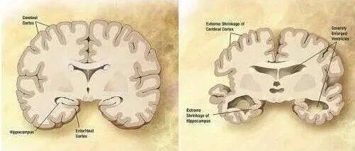 生物谷2020年终巨献｜阿尔兹海默病研究领域重要研究成果解读！