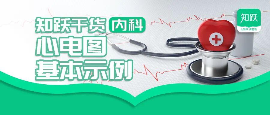 心电图滤波怎么选择【知跃干货】心电图基本示例_https://www.jmylbn.com_新闻资讯_第2张