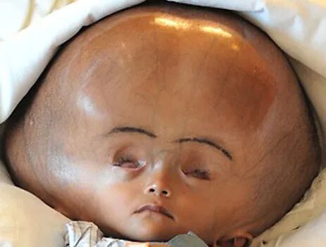 家长注意了大头宝宝可能是因为脑袋里进了水