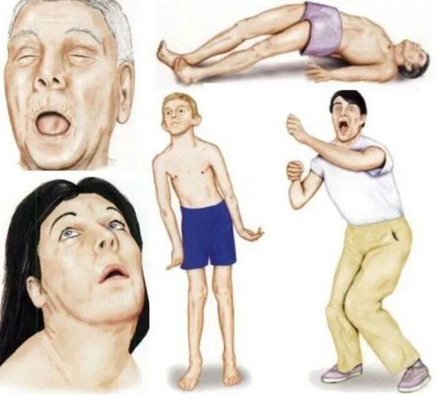 引起的异常运动或/和姿势障碍为特征的一种常见运动障碍性疾病(如图1)