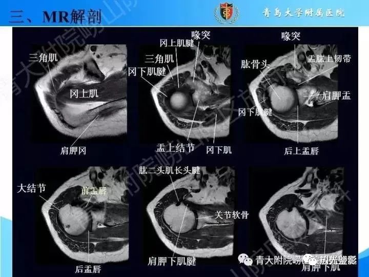 肩关节MRI解剖肩袖损伤诊断技巧--对应动图，效果超赞