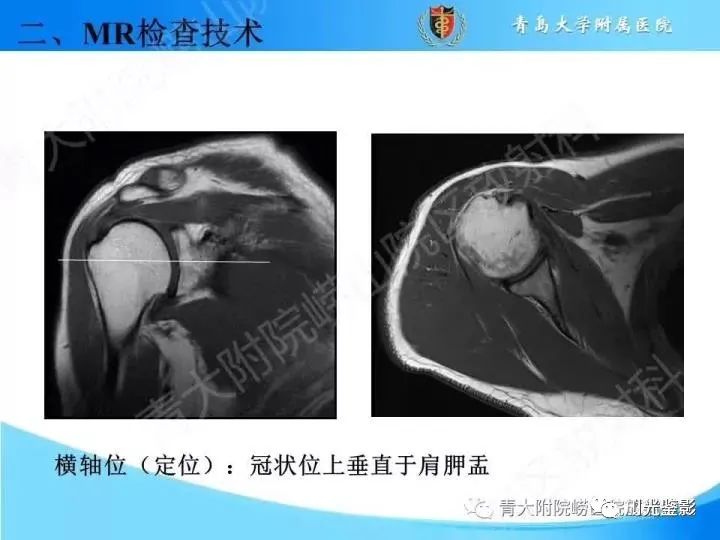 肩关节MRI解剖肩袖损伤诊断技巧--对应动图，效果超赞