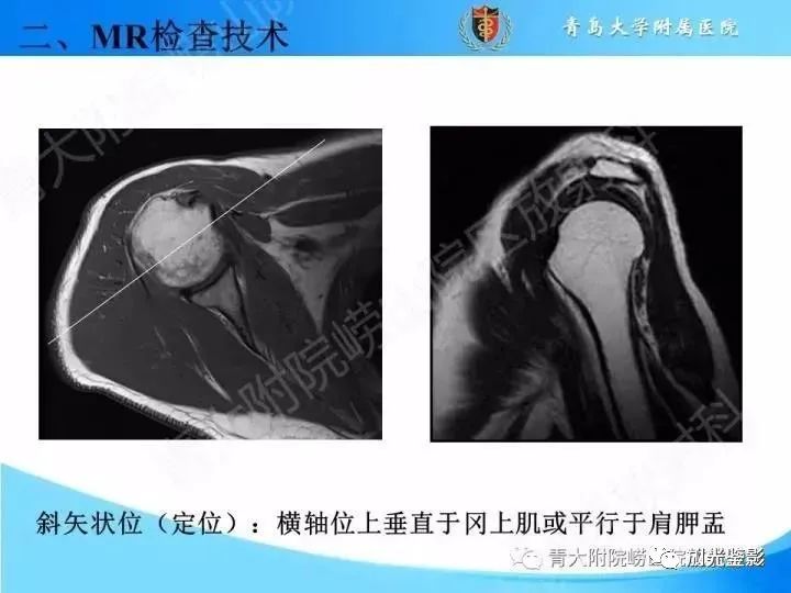 肩关节MRI解剖肩袖损伤诊断技巧--对应动图，效果超赞