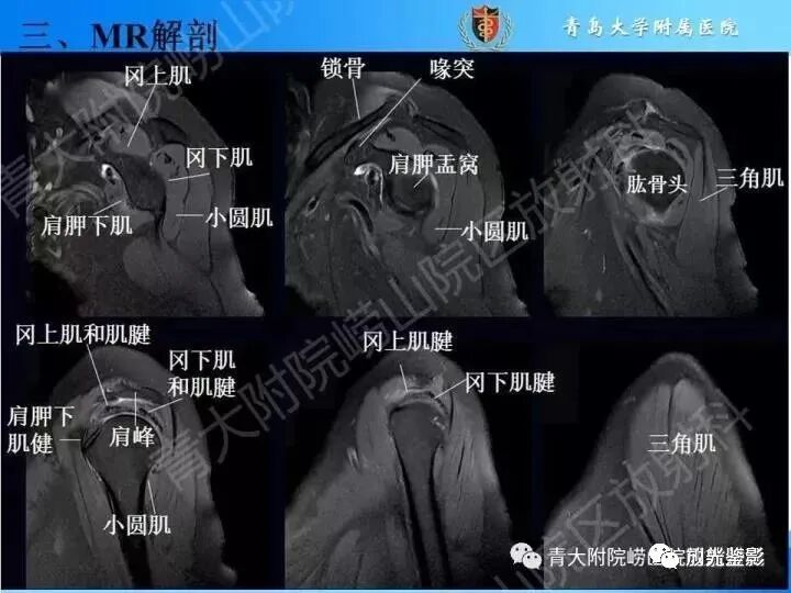 肩关节MRI解剖肩袖损伤诊断技巧--对应动图，效果超赞