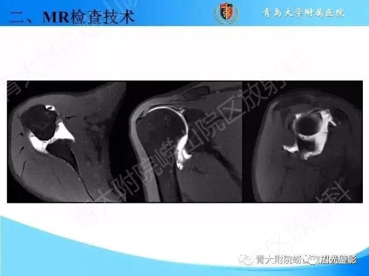 肩关节MRI解剖肩袖损伤诊断技巧--对应动图，效果超赞