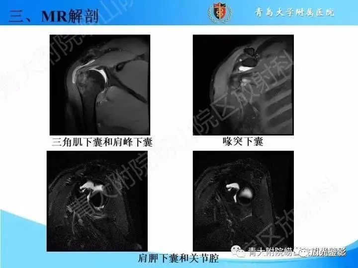 肩关节MRI解剖肩袖损伤诊断技巧--对应动图，效果超赞