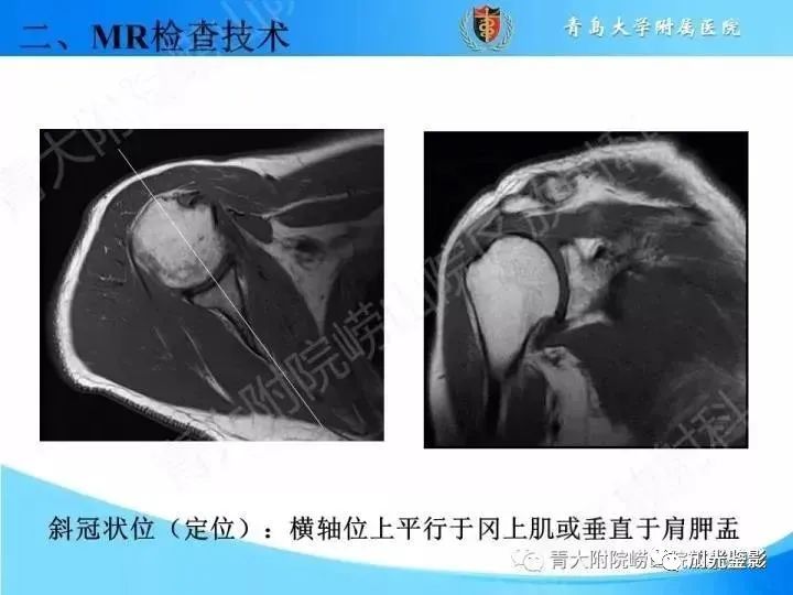 肩关节MRI解剖肩袖损伤诊断技巧--对应动图，效果超赞