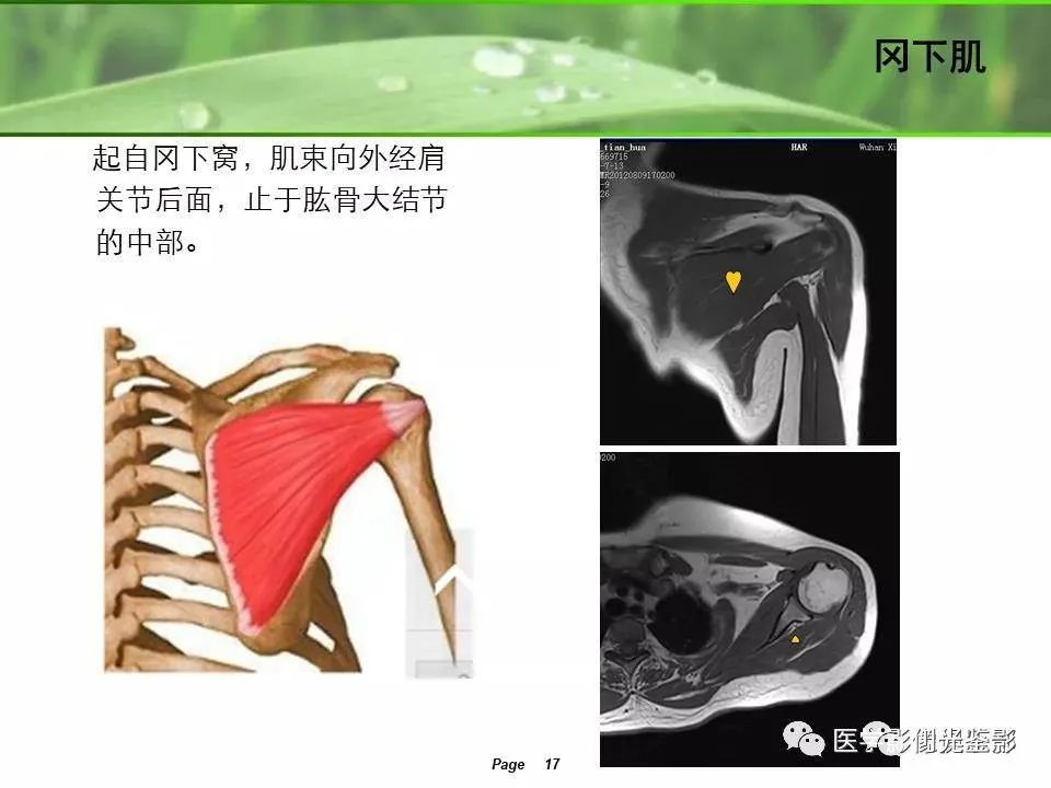 肩关节MRI解剖肩袖损伤诊断技巧--对应动图，效果超赞
